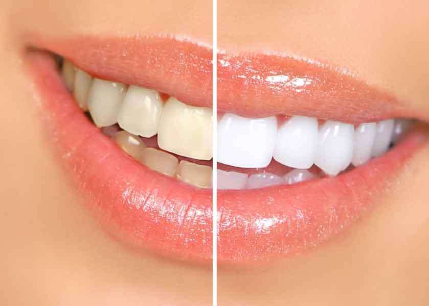 Natural Teeth Whitening Remedies Work