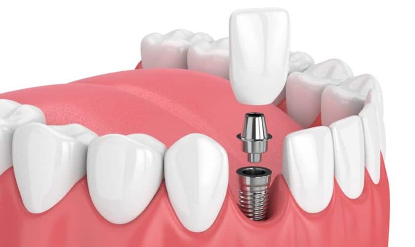 Artificial Tooth Roots